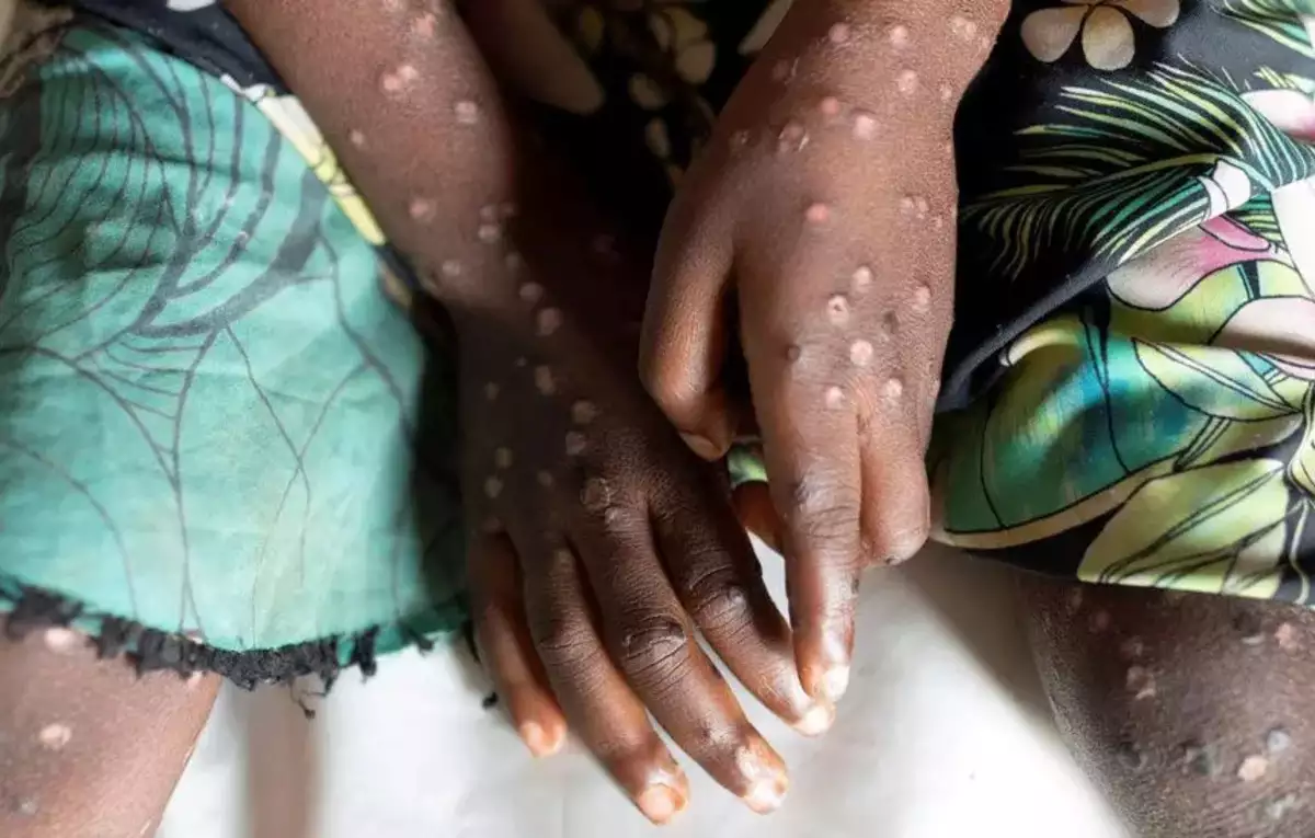 Mpox Is Not Under Control In African Continent